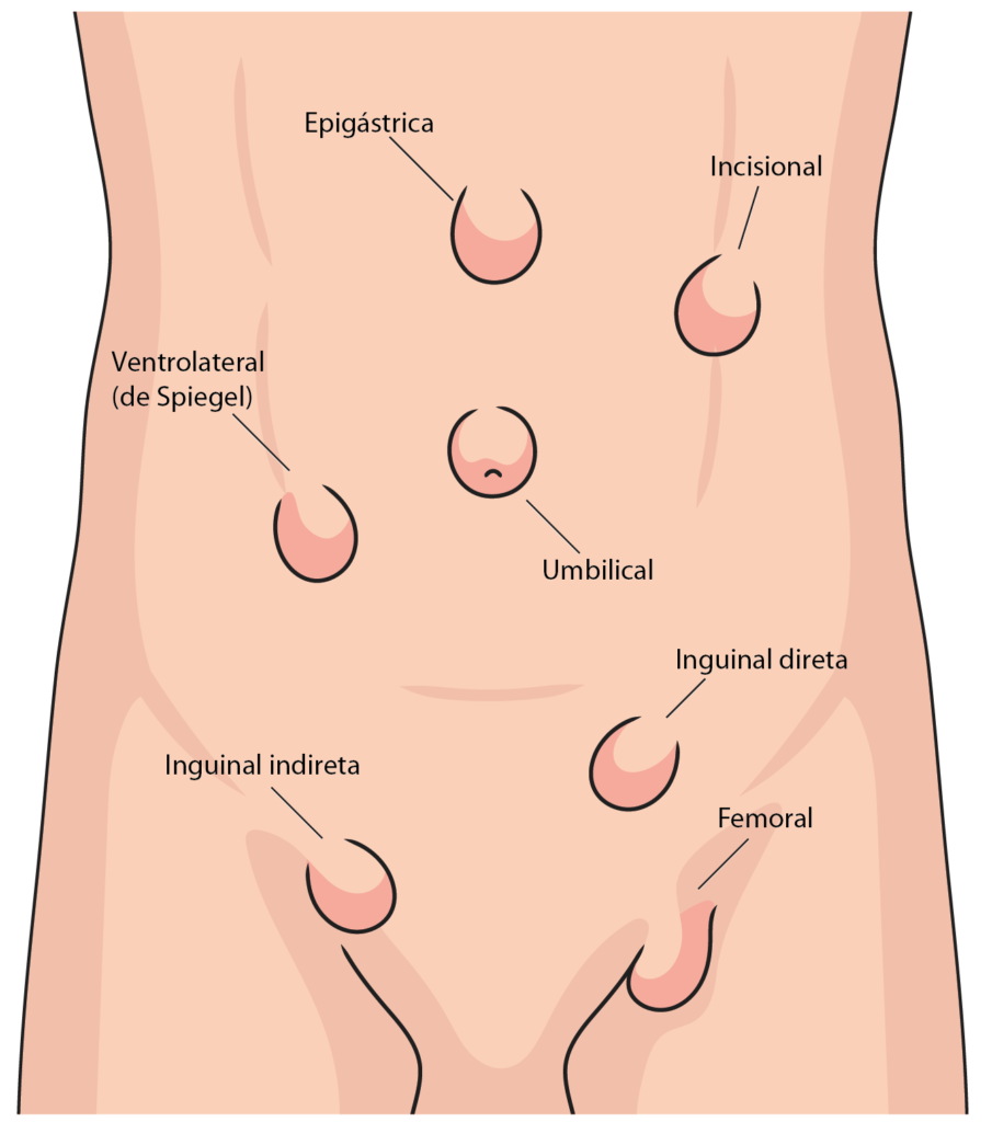hernia abdominal