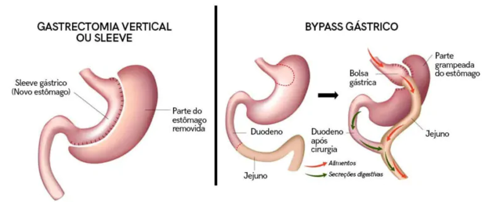 cirurgia bariatrica