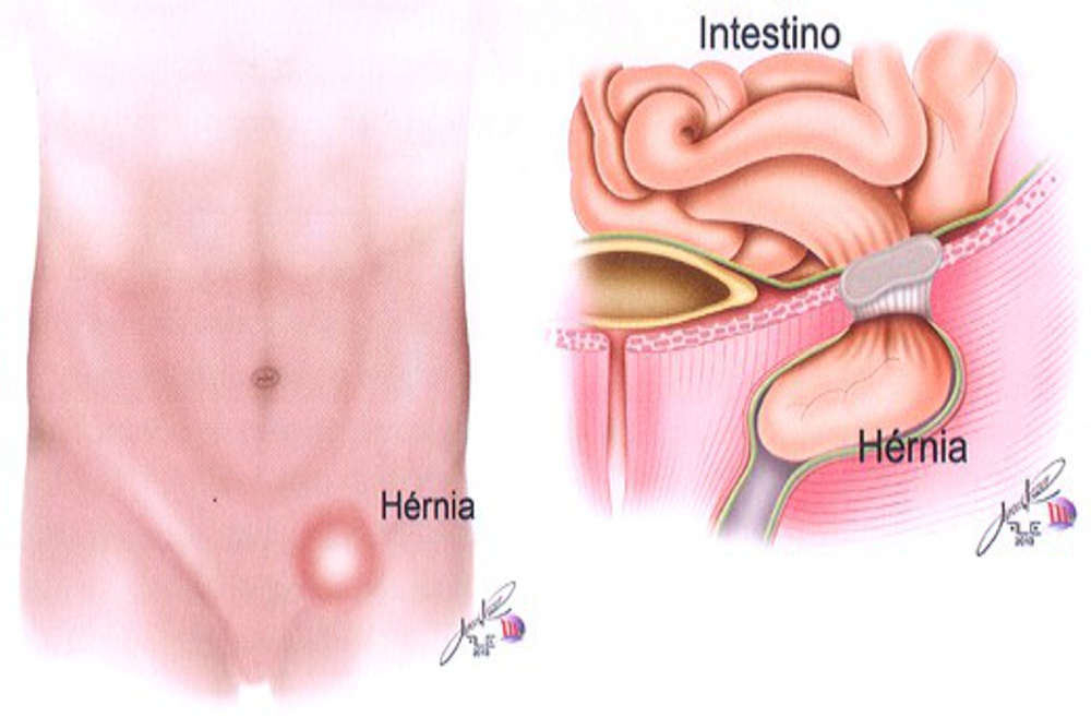 hernia inguinal